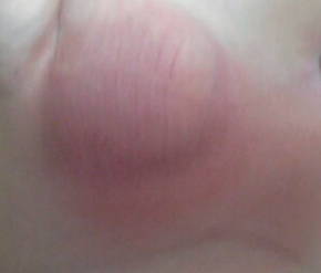 acute scrotal pain_purplish erythema